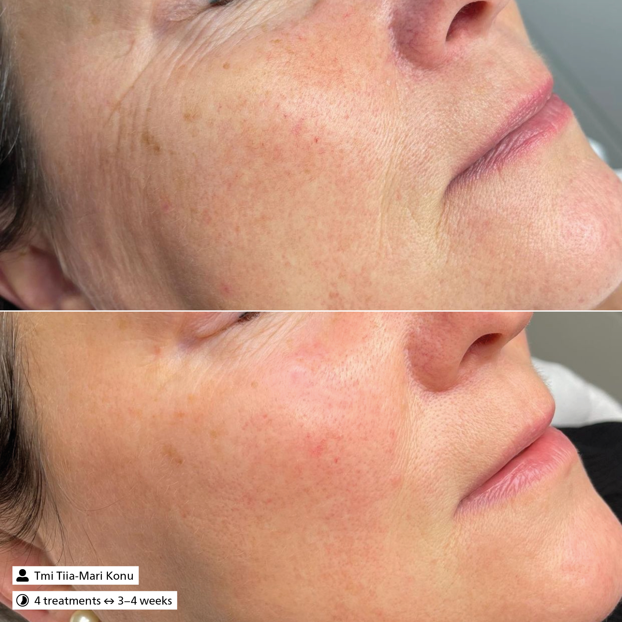 Couperose Control Serum