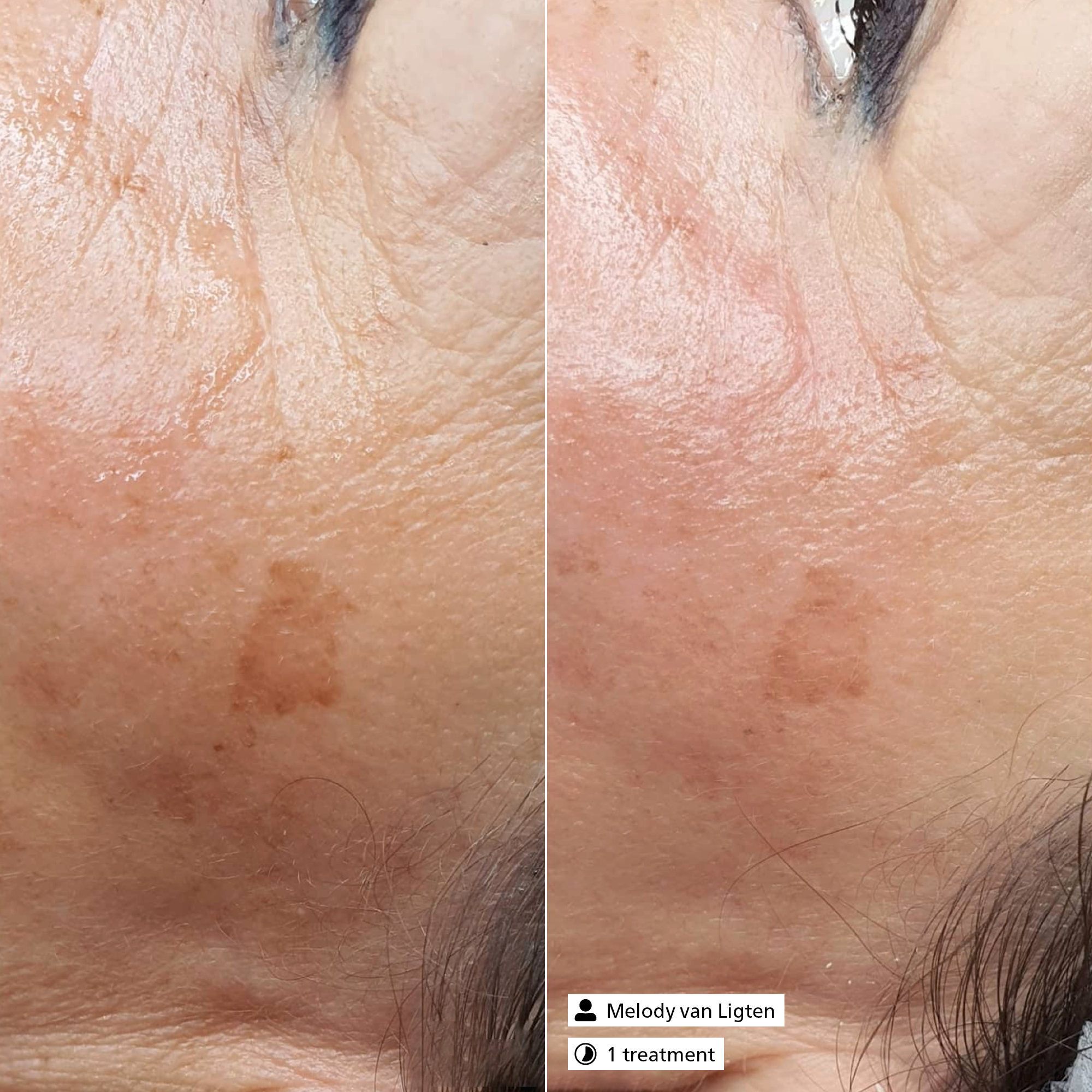 Anti-Pigment Serum