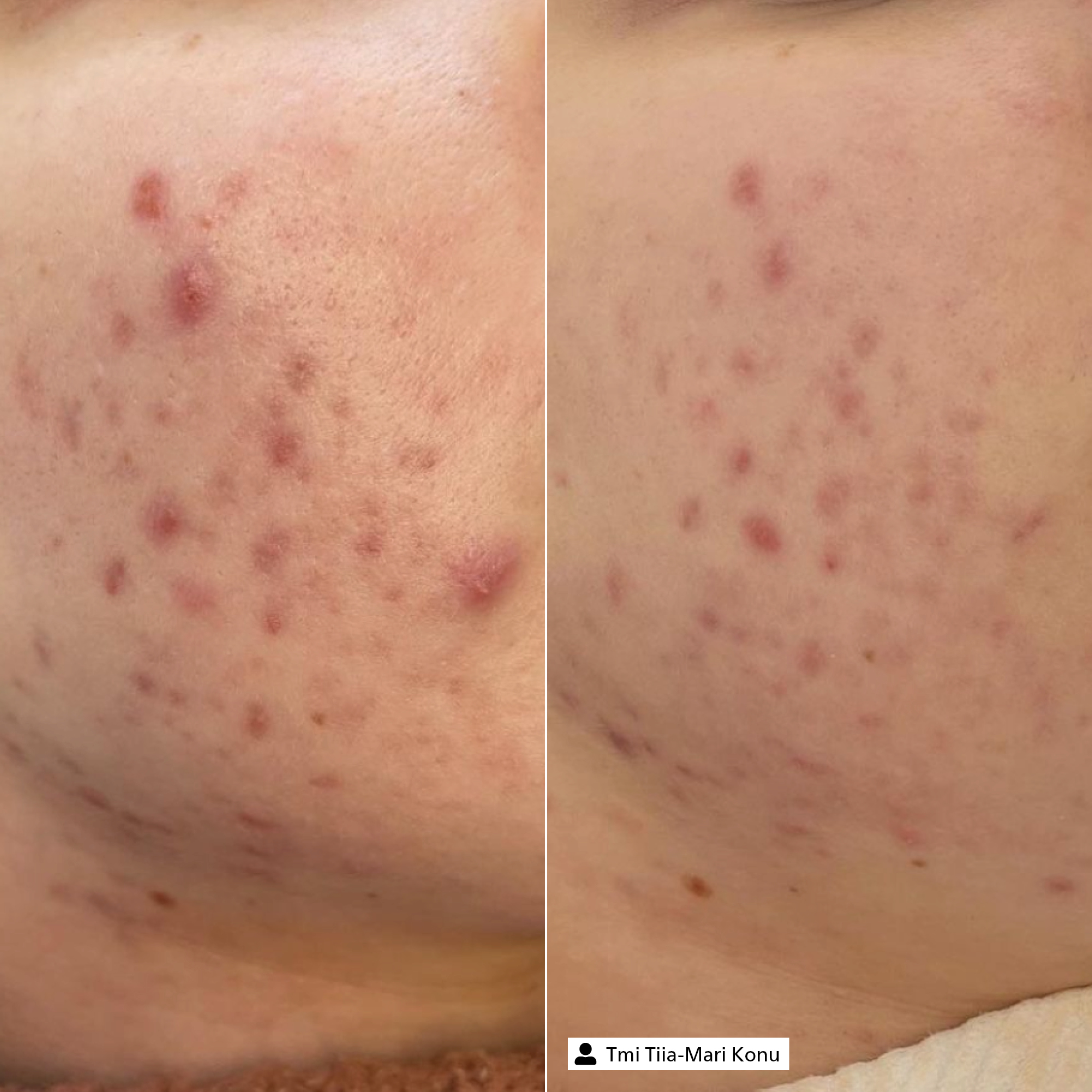 Blemish Control Serum Blemish Control Serum