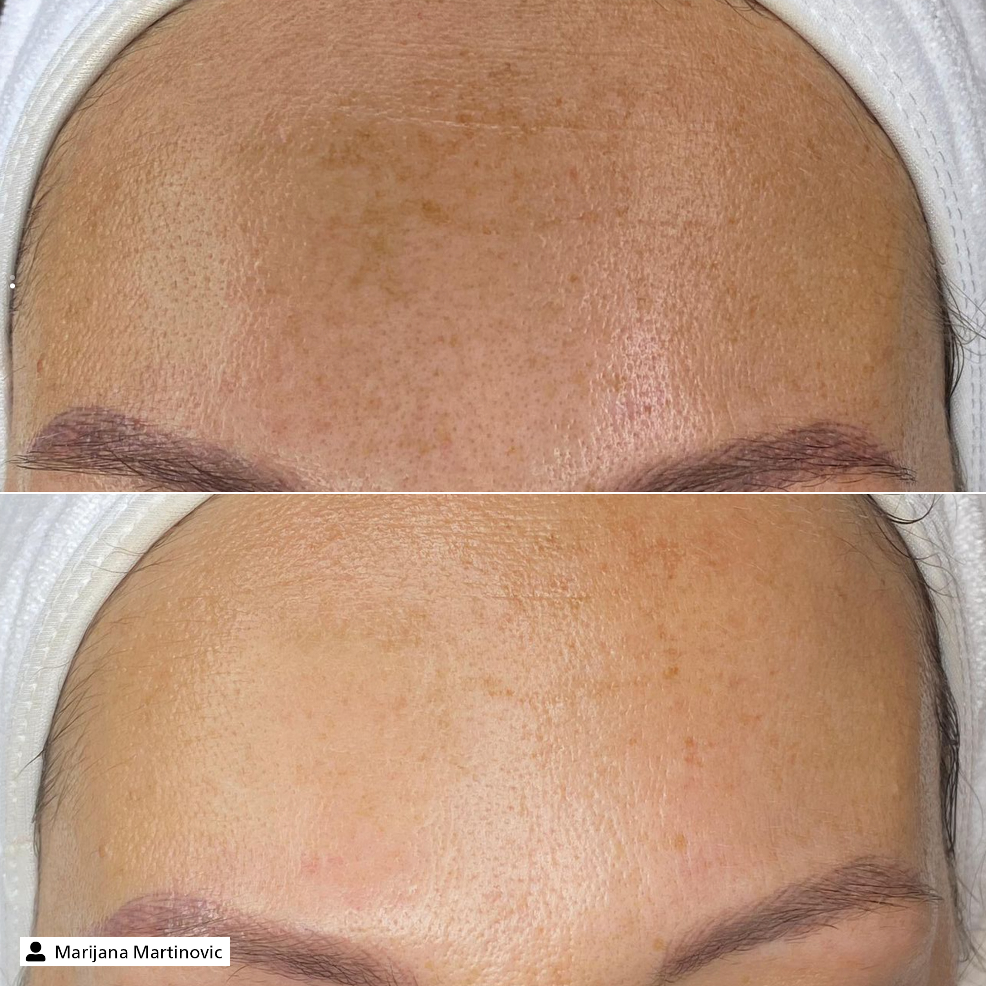 Anti-Pigment Exfoliator