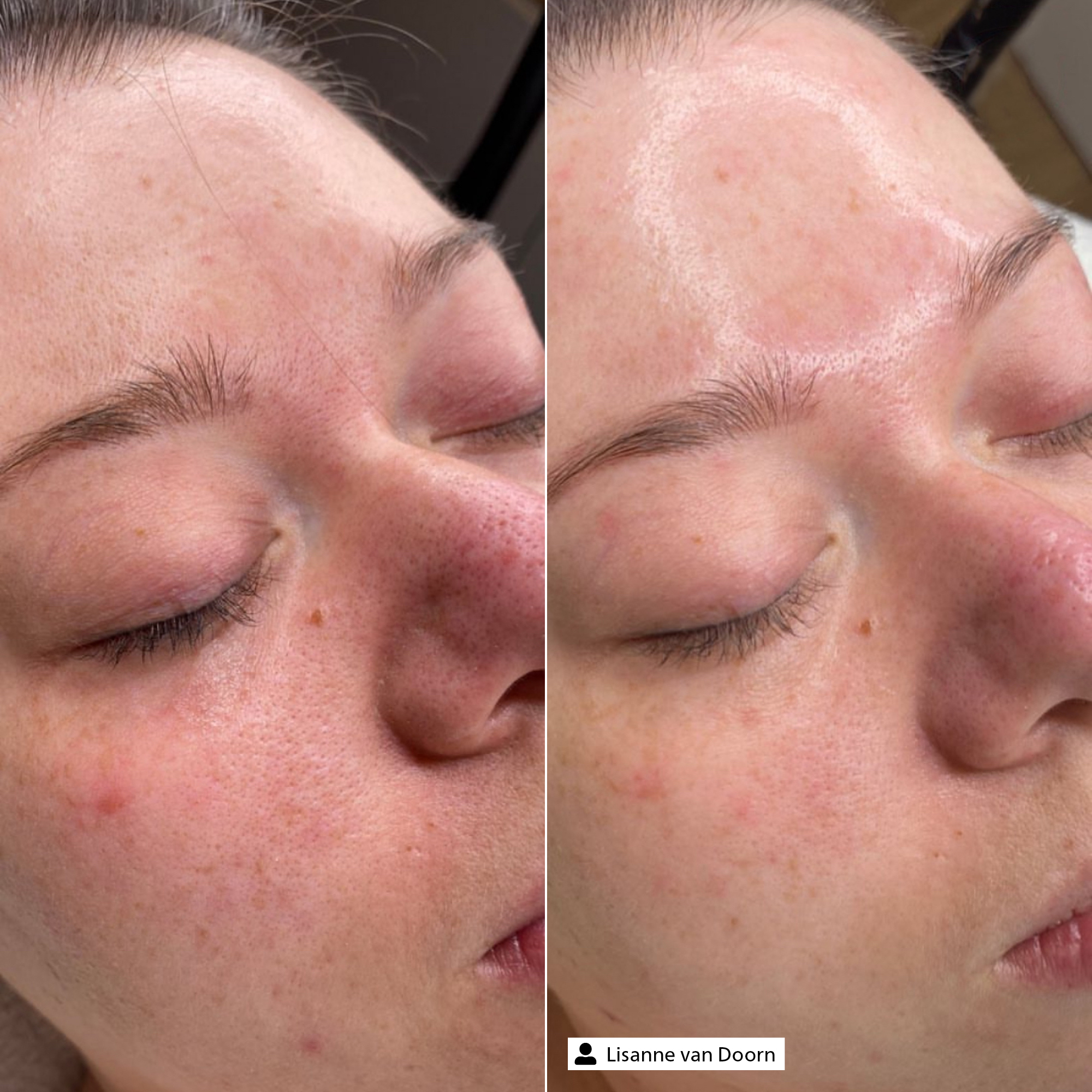 BHA Exfoliator BHA Exfoliator