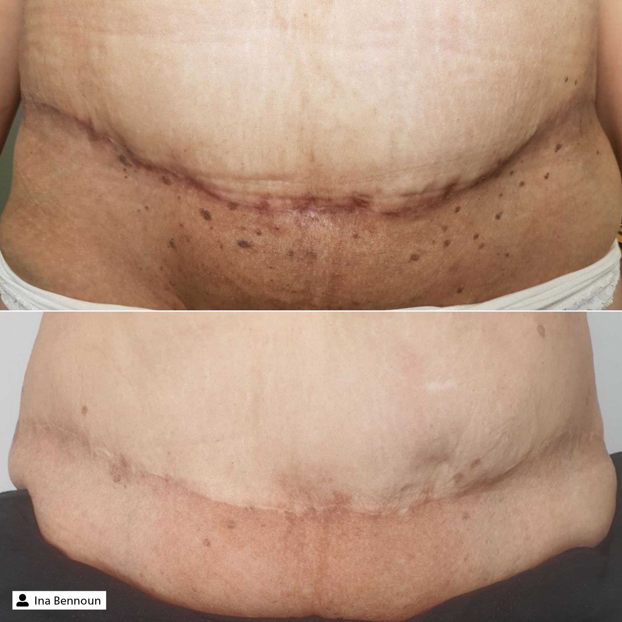 Scar Repair Cream