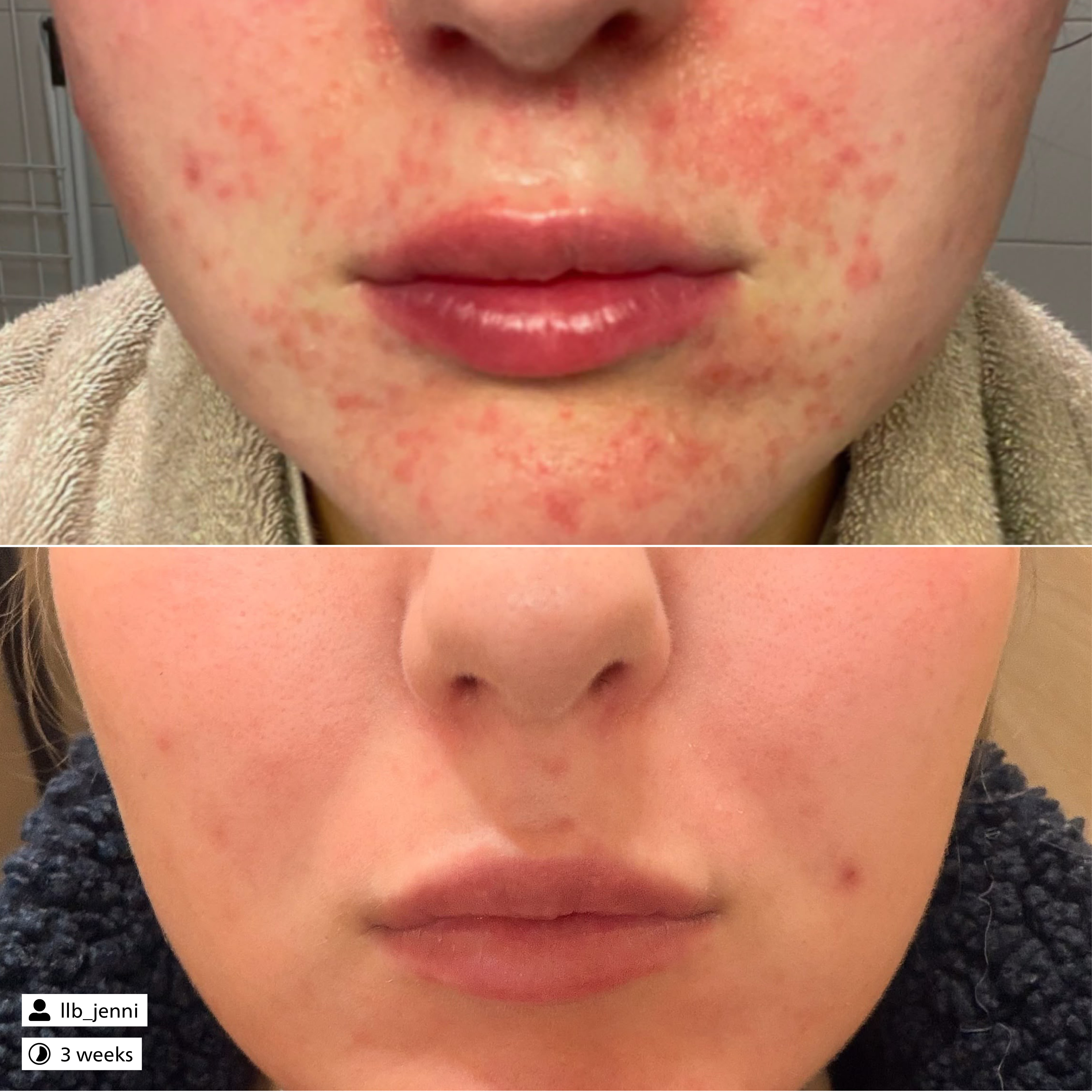 Blemish Control Serum