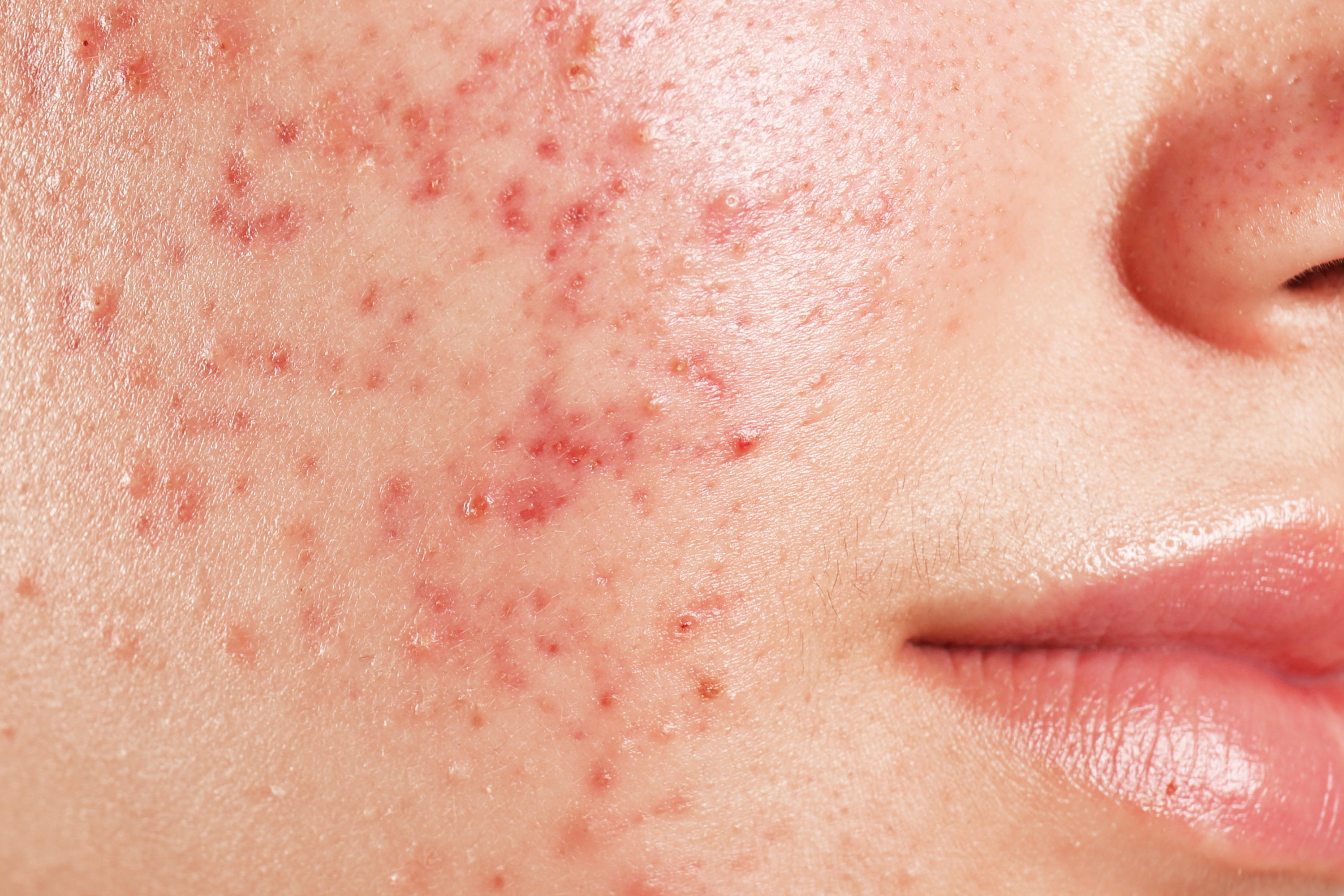 dsr_category_acne_1